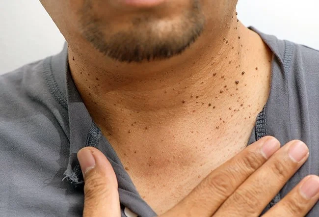 إزالة الزوائد الجلدية والأثاليل