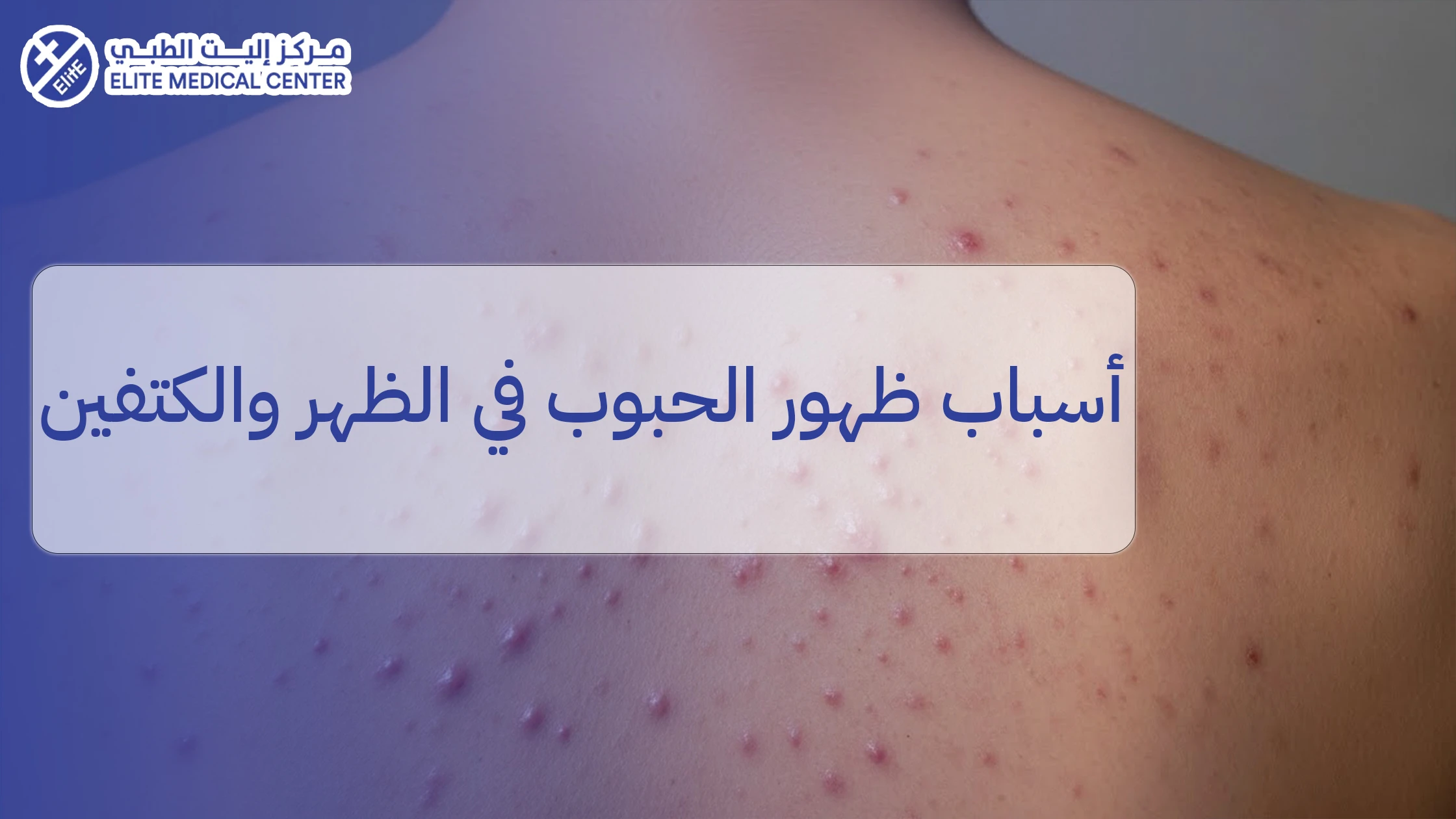 أسباب ظهور الحبوب في الظهر والكتفين: لماذا تظهر؟ وكيف نفهم طبيعتها؟
