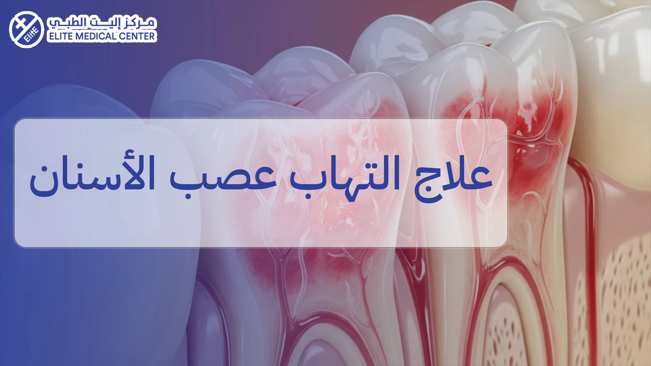 علاج التهاب عصب الأسنان: الأسباب، الأعراض، وخيارات العلاج المتاحة