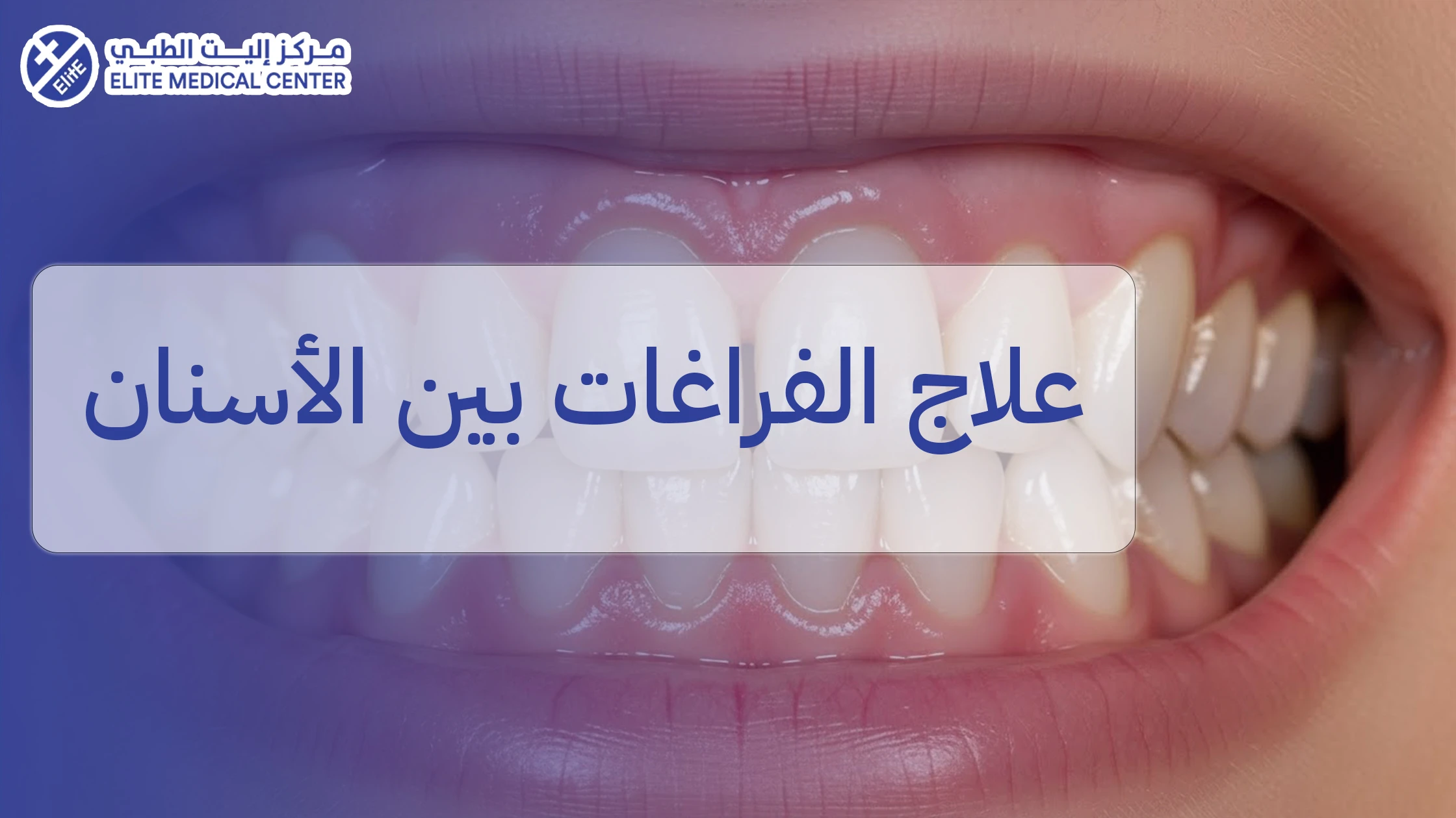 علاج الفراغات بين الأسنان: الأسباب، الأنواع، والحلول المتاحة لكل حالة