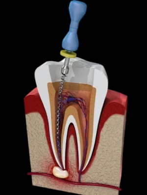 علاج عصب سن خلفي